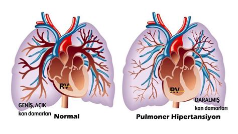 Hipertonik hastalık. Arteriyel hipertansiyonun türleri, dereceleri ve tedavisi